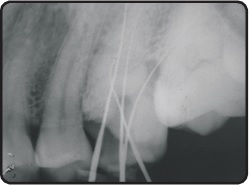 Two palatal canals visible