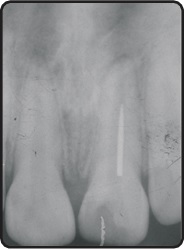Initial preoperative radiograph with metal pin